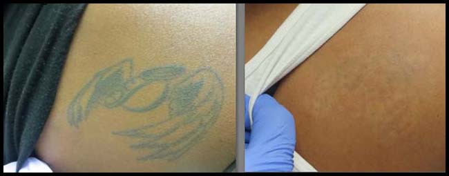 Vanish Medical Spa | The Best Laser Tattoo Removal Specialists in Laredo TX